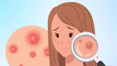 Nguyên nhân gây mụn trứng cá dai dẳng và cách kiểm soát hiệu quả