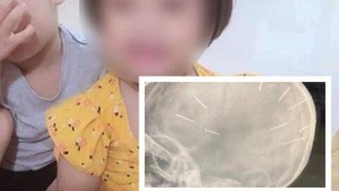 Cục Trẻ em đề nghị xử  nghiêm vụ bé gái 3 tuổi bị đinh  găm vào sọ