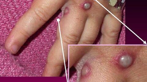 Mỹ xác nhận ca bệnh hiếm gặp đầu tiên lây lan ở châu Âu