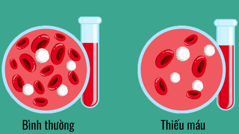 4 dấu hiệu cho thấy thận bắt đầu suy hỏng: Có 1 cũng cần đi khám ngay