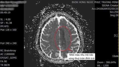 Cứu bệnh nhân đột quỵ thoát liệt người bằng phương pháp Tiêu sợi huyết