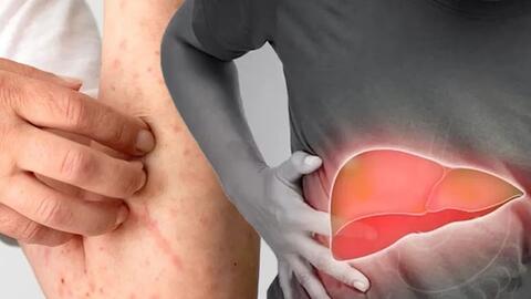 Biểu hiện cảnh báo gan đang hoạt động kém bạn không nên bỏ qua
