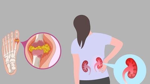Axit uric tăng cao, coi chừng sỏi thận