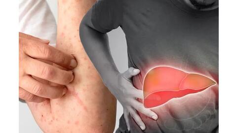 Biểu hiện cảnh báo gan đang hoạt động kém bạn không nên bỏ qua