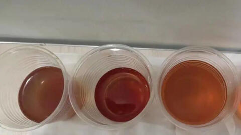 3 bất thường khi đi vệ sinh cảnh báo gan đã “xác xơ”, ngày nào cũng gồng mình chiến đấu với bệnh tật trong im lặng