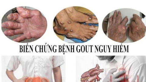 Cơn đau gút về đêm: Hãy cẩn trọng