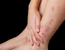 Lupus ban đỏ - Bệnh tự miễn khó trị ảnh 1