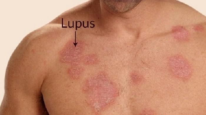 Lupus ban đỏ - Bệnh tự miễn khó trị ảnh 2