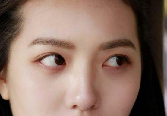 Cô sinh viên bị đột quỵ mắt, da nhăn nheo "già nua" chỉ vì 1 thói quen ban đêm, nhiều người trẻ vẫn hay làm - Ảnh 3.