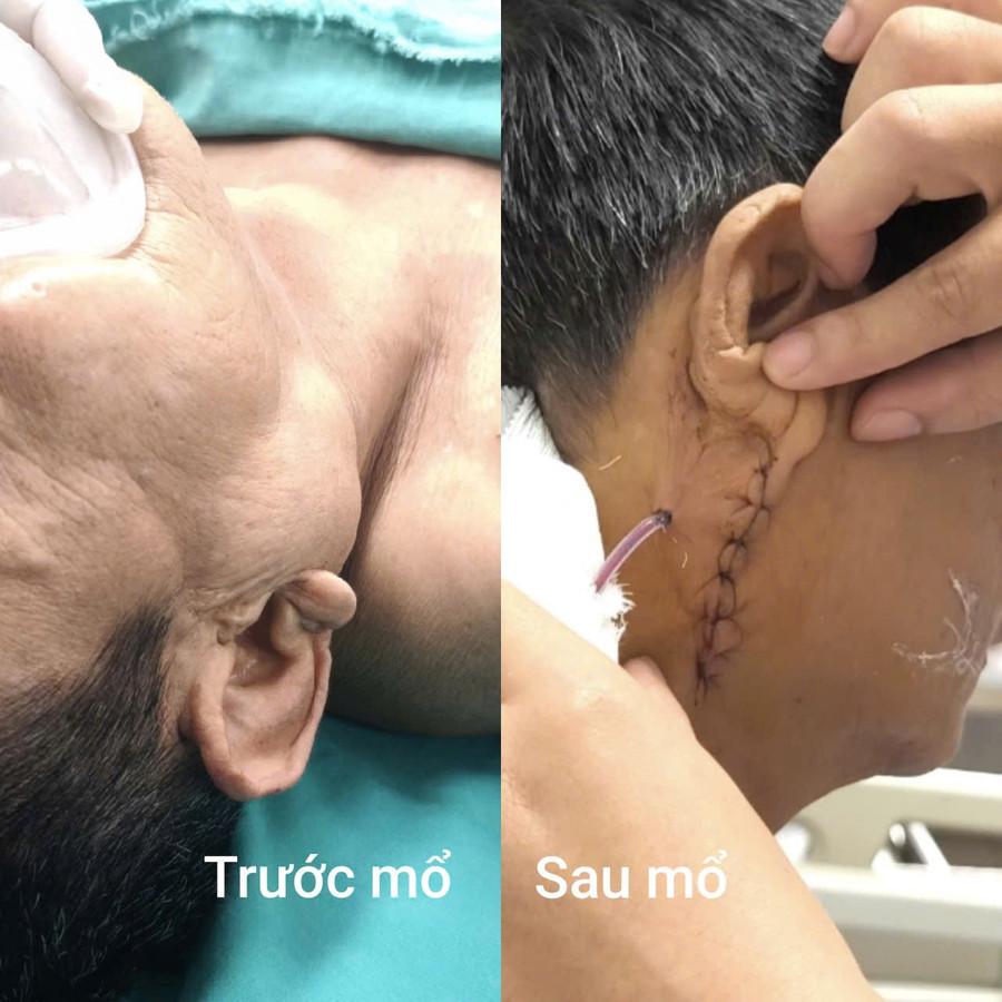 Hình ảnh bệnh nhân trước và sau phẫu thuật. Ảnh: BVCC