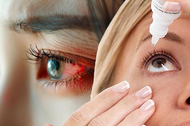 Viêm kết mạc do hóa chất: Triệu chứng và cách phòng ngừa