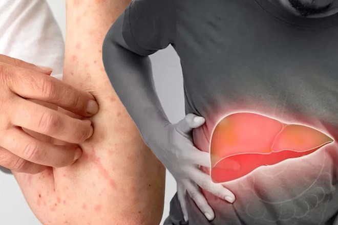 Biểu hiện cảnh báo gan đang hoạt động kém bạn không nên bỏ qua