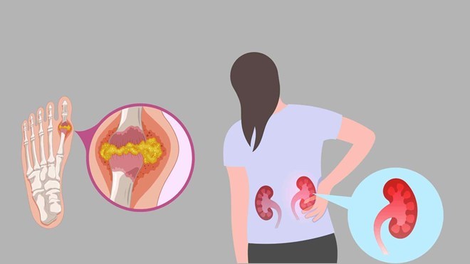 Axit uric tăng cao, coi chừng sỏi thận